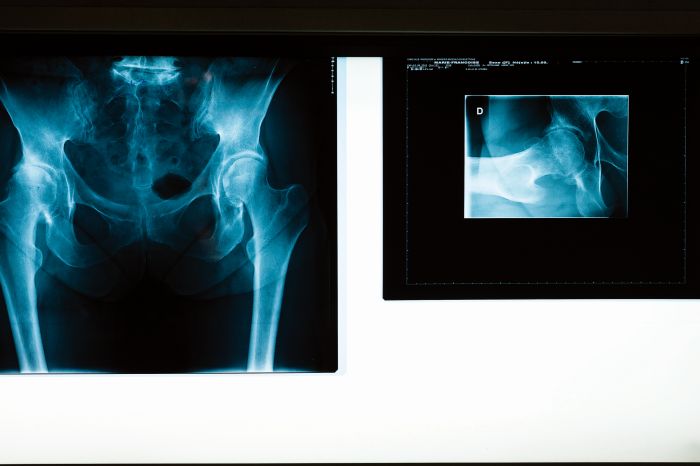 Radiographie de la hanche